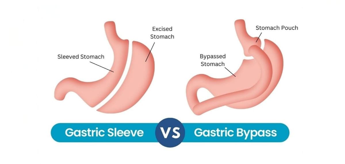 روش‌های موثر جراحی برای درمان چاقی: اسلیو و بای‌پس معده